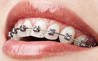 Traditional, Ceramic or Clear: Which Braces to Choose?