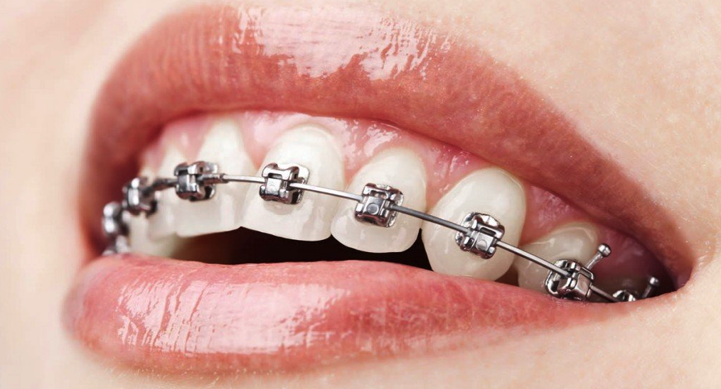 Traditional, Ceramic or Clear: Which Braces to Choose?