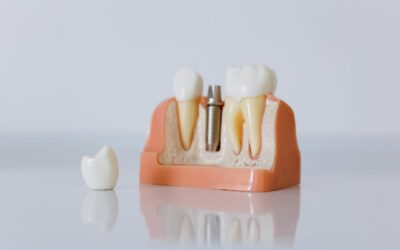 What Are Dental Implants and Why Are They the Fastest-Growing Tooth Replacement Option