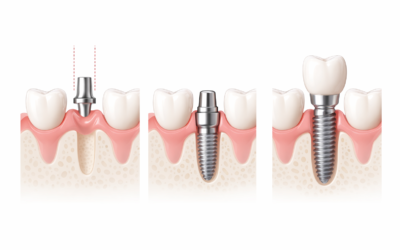 Dental Implant Timeline: From Consultation to Final Crown
